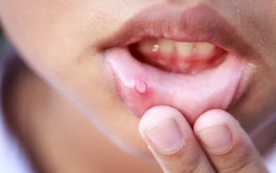 Todo lo que deberías saber con las aftas bucales y cómo prevenirlas