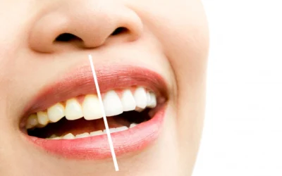 Blanqueamiento dental