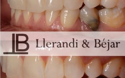 Blanqueamiento interno en dientes endodonciados