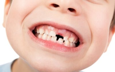 Caída de dientes ¿Cuáles son las causas?¿Cómo evitarla?