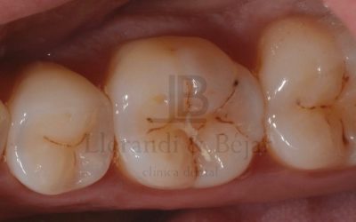 ¿Sabías que no todas las manchas oscuras son caries?