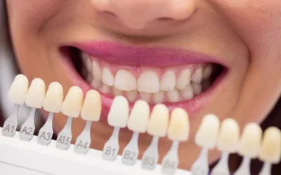 Carillas dentales ¿Qué son? ¿Para que sirven?