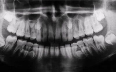 Dientes supernumerarios ¿qué son? ¿cuáles son sus causas? ¿cómo se tratan?