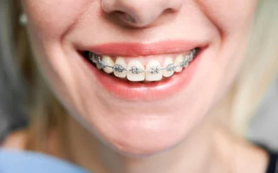 ¿Cómo saber que brackets elegir?