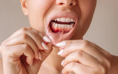 Gingivectomía o alargamiento coronario
