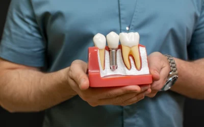 ¿Qué porcentaje de éxito tienen los implantes?