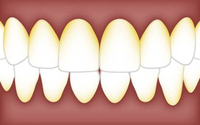Sarro en los dientes ¿Qué es? ¿Cómo eliminarlo?