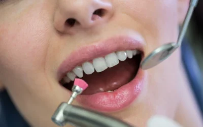 ¿Cuándo hacerse una limpieza dental? Y otras preguntas frecuentes.