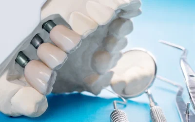 Implantes, puentes y sobredentadura